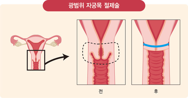 자궁목 절제술./사진 = 강동경희대병원